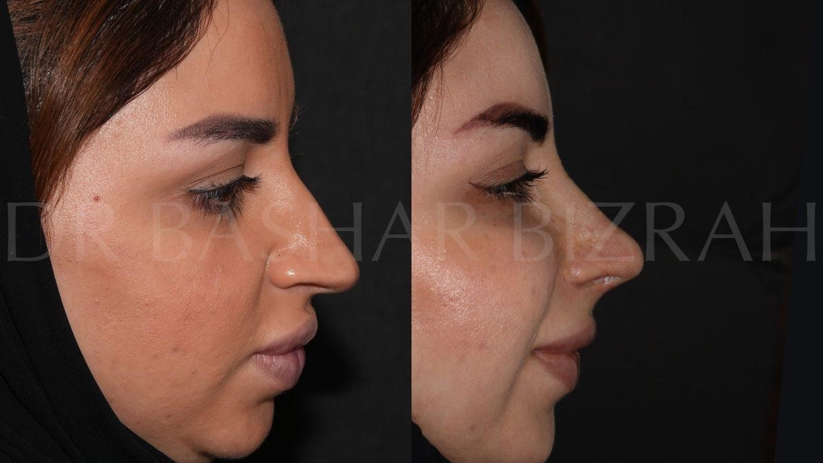 rhinoplasty surgery near me