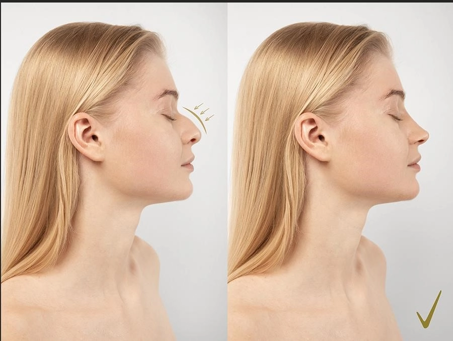 rhinoplasty surgery near me