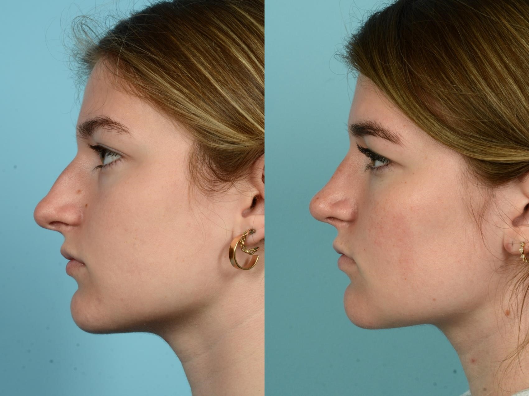 rhinoplasty surgery near me